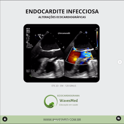 Achados ecocardiográficos de endocardite infecciosa Wavesmed