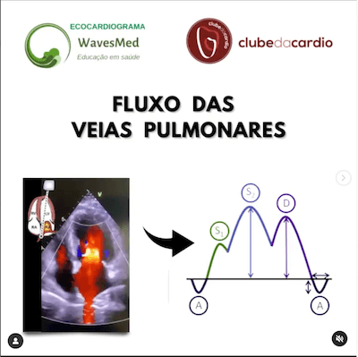 Ecocardiograma avaliação veias pulmonares Wavesmed
