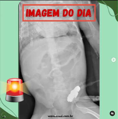 Cateter venoso central: Complicações