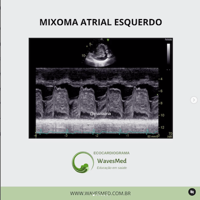 Mixoma atrial