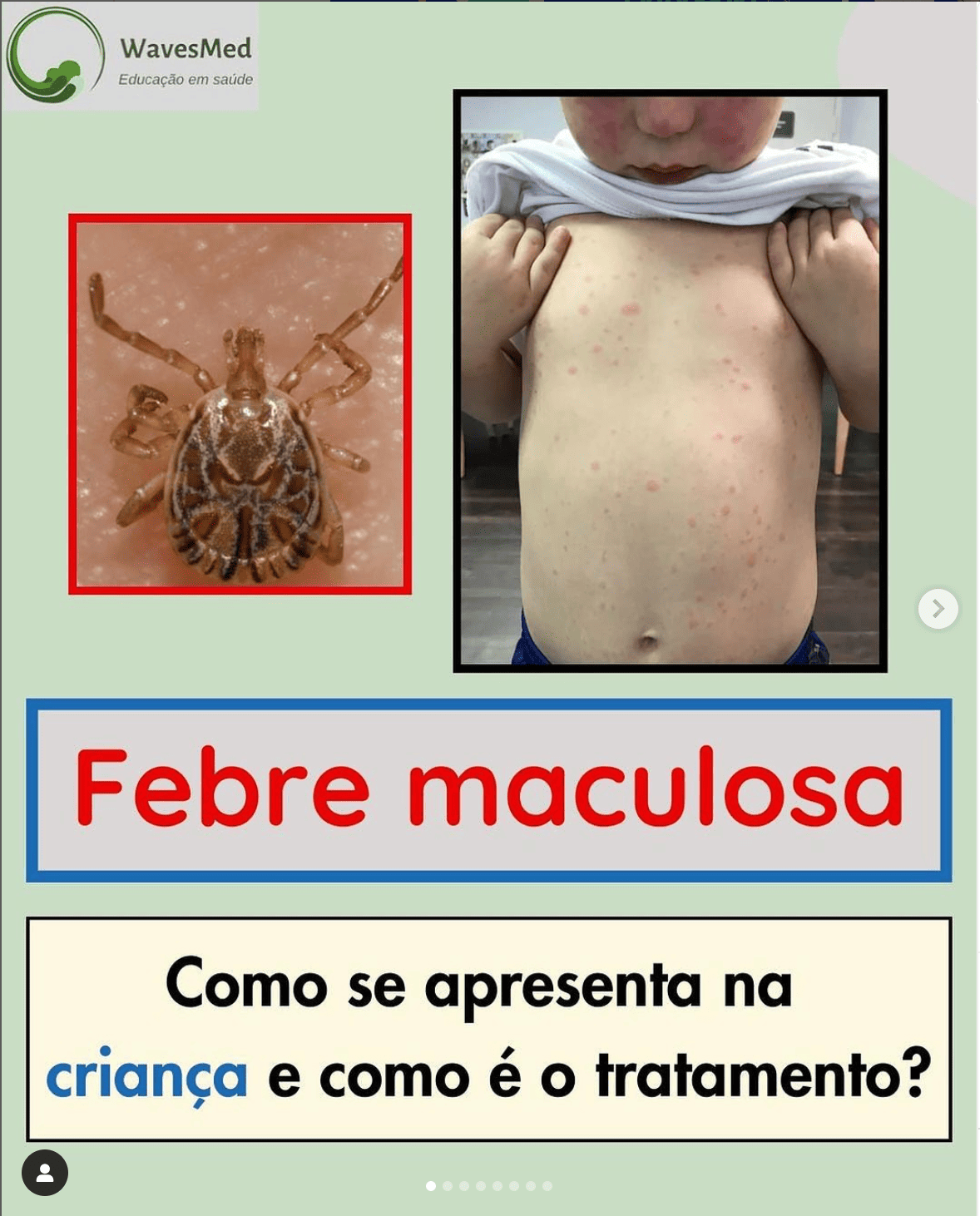 FEBRE MACULOSA