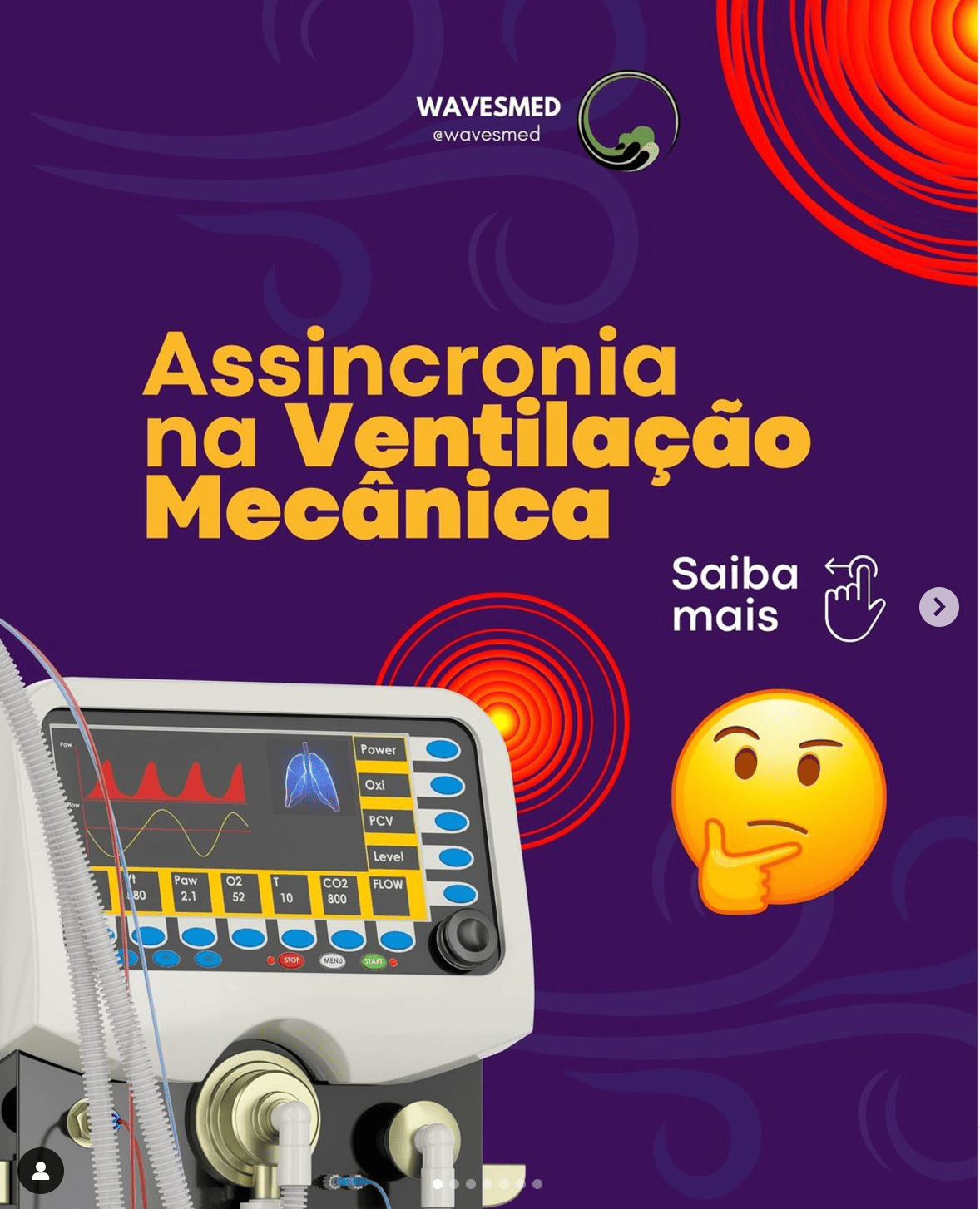 ASSINCRONIA NA VENTILAÇÃO MECÂNICA