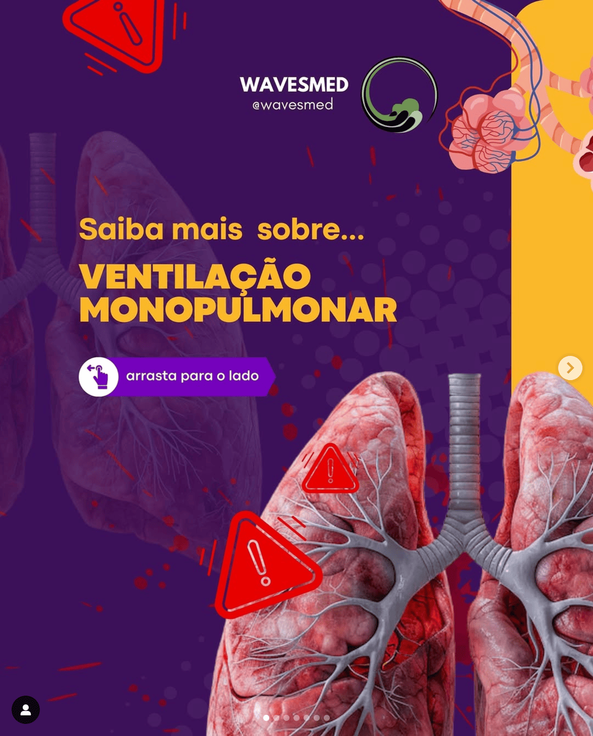VENTILAÇÃO MONOPULMONAR