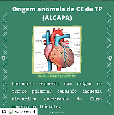 Definição origem anômala coronária esquerda alcapa Wavesmed