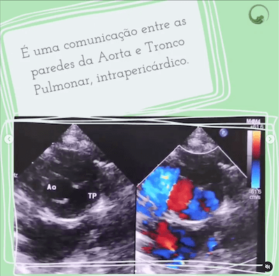 Definição janela aorto pulmonar Wavesmed.png