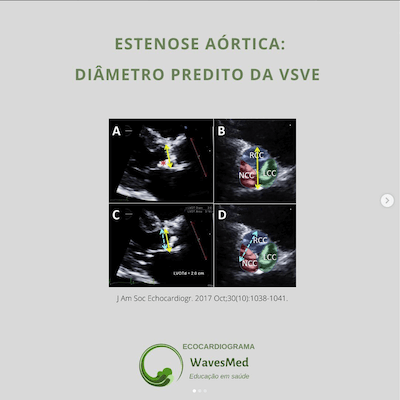 Estenose aórtica diâmetro vsve Wavesmed