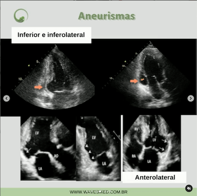 Aneurismas miocardiopatia chagásica Wavesmed