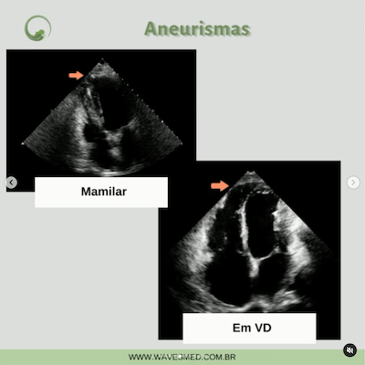 Aneurismas miocardiopatia chagásica Wavesmed