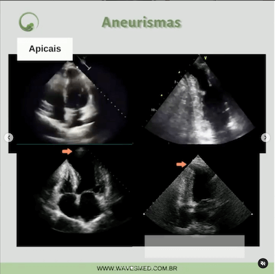 Aneurismas ecocardiograma miocardiopatia chagásica Wavesmed