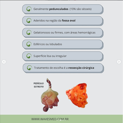 Anatomia mixoma Wavesmed