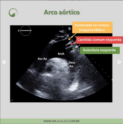 Arco aórtico anatomia aorta Wavesmed