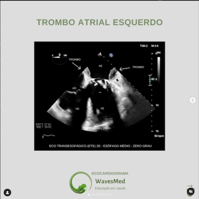 Trombo atrial esquerdo Wavesmed