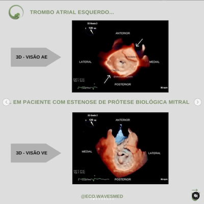 3D trombo atrial esquerdo Wavesmed