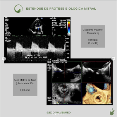 Estenose prótese biológica trombo atrial esquerdo Wavesmed