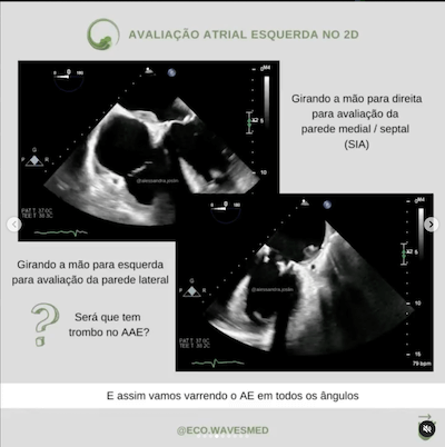 2D trombo atrial esquerdo Wavesmed