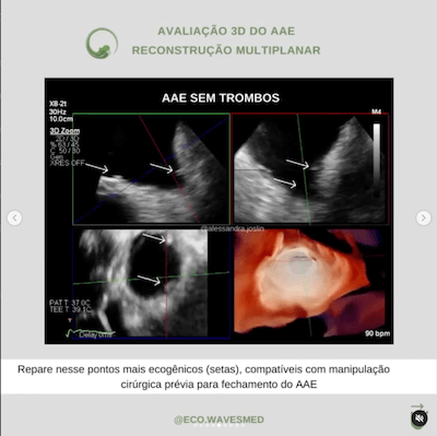 Multiplanar trombo atrial esquerdo Wavesmed