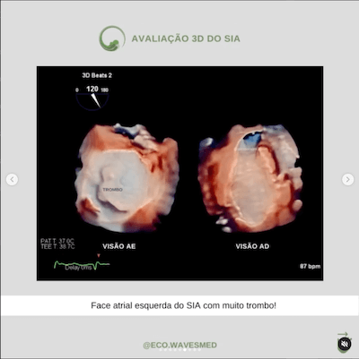 Face atrial trombo atrial esquerdo Wavesmed