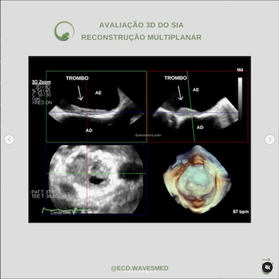 Reconstrução multiplanar trombo atrial esquerdo Wavesmed