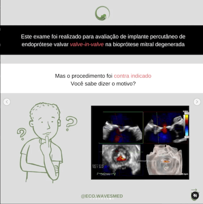 Valve in valve trombo atrial esquerdo Wavesmed