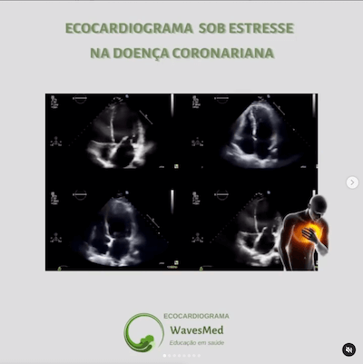 eco estresse Wavesmed  Curso preparatorio prove de titulo de ecocardiografia Wavesmed