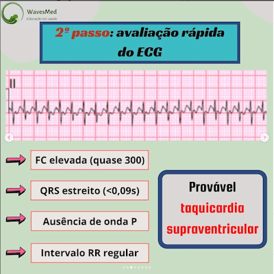 Taquicardia supraventricular Wavesmed  Avaliação do ECG