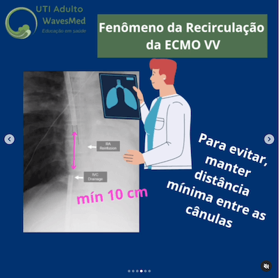 Tipo de ECMO Wavesmed  Recirculação da ECMO veno-venosa (VV)