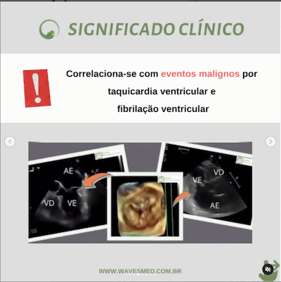 Pickelhaube Sign Wavesmed  Significado clínico