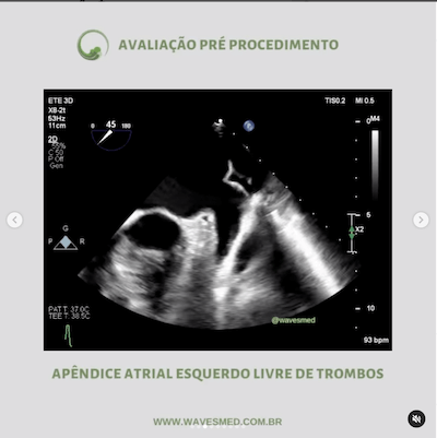 Pré procedimento  Valvoplastia mitral por cateter balão Wavesmed