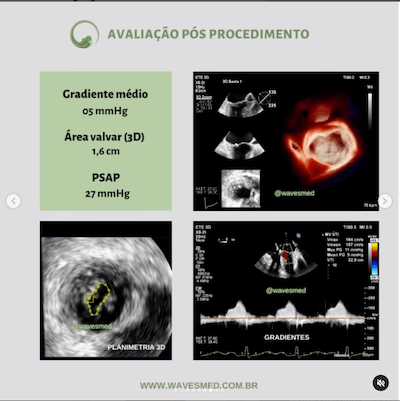 Pós procedimento  Valvoplastia mitral por cateter balão Wavesmed