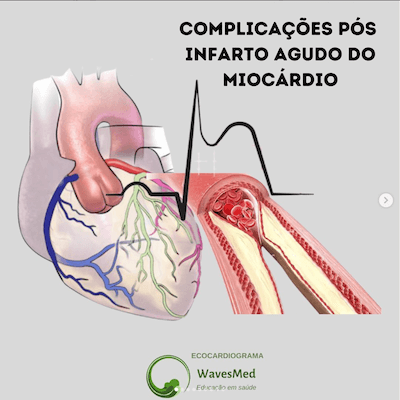 Infarto Agudo do Miocárdio (IAM) - Enfermagem Ilustrada