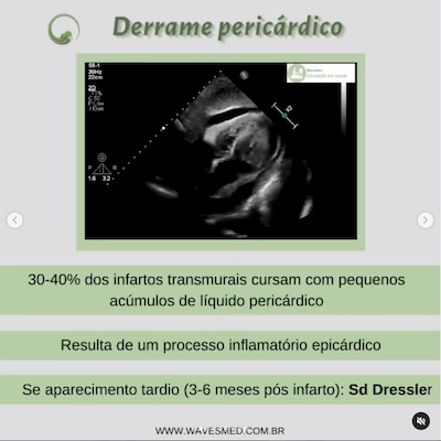 Complicações pós Infarto Agudo do Miocárdico Wavesmed  Derrame pericárdico