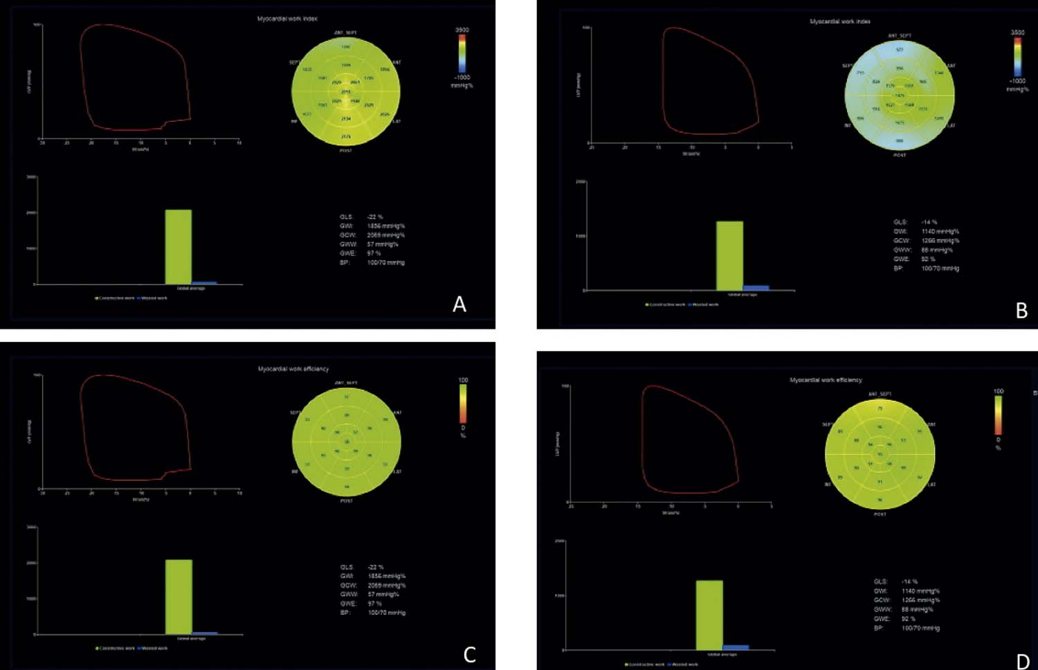 Trabalho Miocárdico na Echocardiografia - Myocardial work 